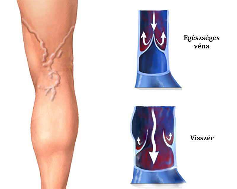 lábkötési technika visszér ellen a varikózisos vénák műtéti eltávolítása